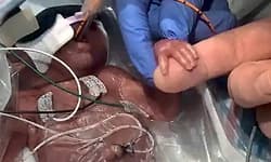 22 ವಾರಕ್ಕೆ ಜನಿಸಿ ಸಾವನ್ನೇ ಗೆದ್ದ 450 ಗ್ರಾಂ ತೂಕದ ಕಂದಮ್ಮ!