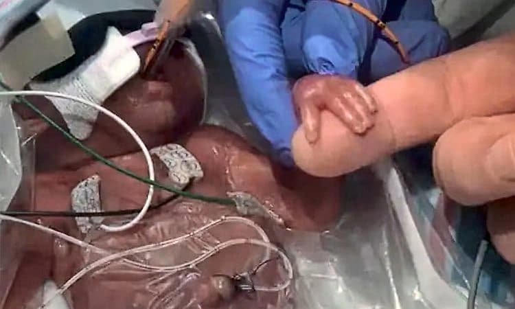 22 ವಾರಕ್ಕೆ ಜನಿಸಿ ಸಾವನ್ನೇ ಗೆದ್ದ 450 ಗ್ರಾಂ ತೂಕದ ಕಂದಮ್ಮ!