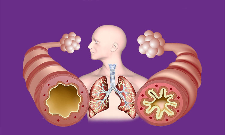 Asthma: ಅಸ್ತಮಾ ಶೀಘ್ರ ಪತ್ತೆ; ಸರಳ ಪರೀಕ್ಷೆಗಳು, ಉತ್ತಮ ಫ‌ಲಿತಾಂಶ