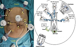 Manipal doctors remove pancreatic cancer using robotic surgery, patient discharged in 7 days