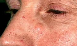 Lump: ಮುಖದ ಮೇಲಿನ ಗೆಡ್ಡೆ ಕ್ಯಾನ್ಸರ್‌ ಅಲ್ಲದಿದ್ದರೂ ನಿರ್ಲಕ್ಷ್ಯ ಬೇಡ