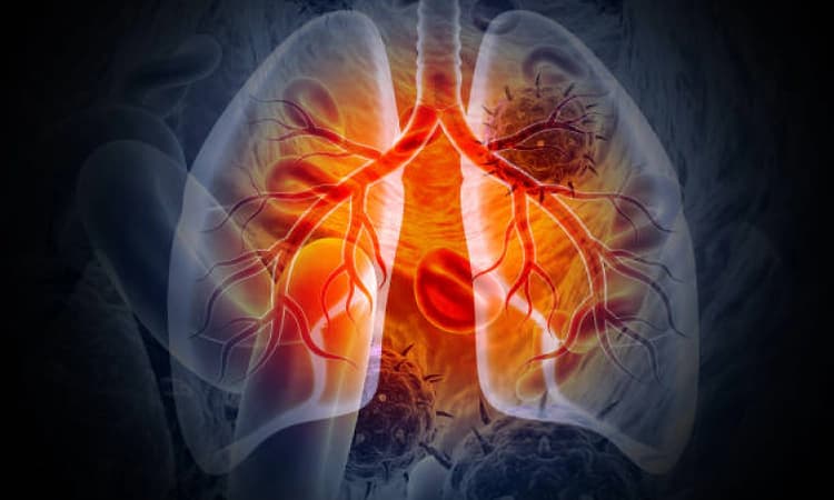 A Pulmonologist's Blueprint for Better Lung Health During Winter