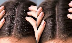 Dandruff: ತಲೆಹೊಟ್ಟು ನಿವಾರಣೆಗೆ 8 ನೈಸರ್ಗಿಕ ಮನೆಮದ್ದುಗಳು