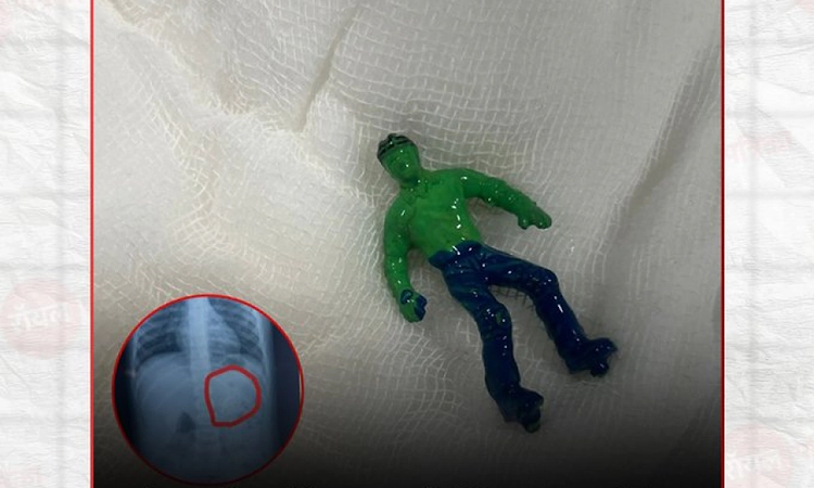 Toddler swallows ‘Hulk’; doctors remove toy via endoscopy