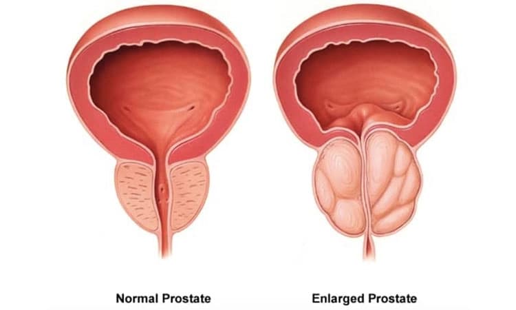 Prostate enlargement: ಪ್ರೋಸ್ಟೇಟ್‌ ಹಿಗ್ಗುವಿಕೆ- ಗಮನ ಕೊಡಬೇಕಾದ ಪುರುಷರ ಸಮಸ್ಯೆ