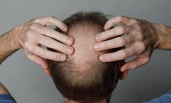 Noida: Woman accuses husband of concealing baldness, income; FIR registered