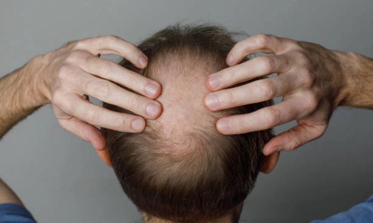 Noida: Woman accuses husband of concealing baldness, income; FIR registered