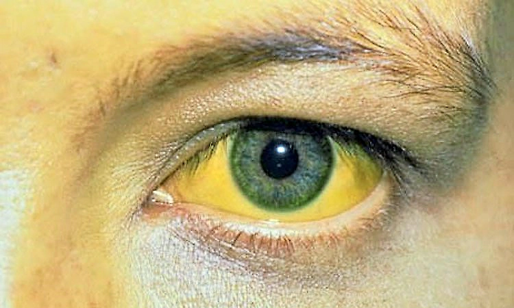 Jaundice alert in Mangaluru: 15 cases reported in a week