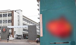 Kasturba Hospital, Manipal, removes a kidney Tumor that had spread into the heart 