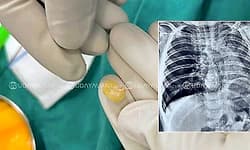 ಶ್ವಾಸನಾಳದಲ್ಲಿ ಕಡಲೇಬೀಜ ಸಿಲುಕಿ ಉಸಿರಾಟದ ತೊಂದರೆ: ವೈದ್ಯರಿಂದ 10 ತಿಂಗಳ ಮಗುವಿನ ರಕ್ಷಣೆ