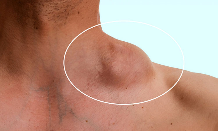  Lymphoma: ಲಿಂಫೋಮಾ ಶೀಘ್ರ ಪತ್ತೆ; ರೋಗ ಲಕ್ಷಣಗಳಿಂದ ಗುಣಮುಖದೆಡೆಗೆ