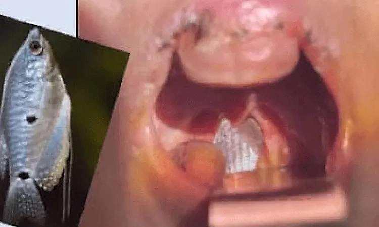 Live fish gets lodged in Indore toddler’s throat; removed after surgery