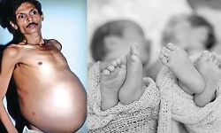 Man unknowingly carried twin brother’s foetus in stomach for 36 years