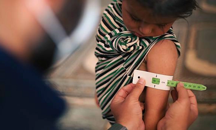 Eliminating undernutrition could prevent up to 2.3 million TB cases globally: Study