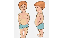 Nearly one in three children in Karnataka affected by stunting