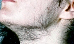 ಮಹಿಳೆಯರೇ, ನಿಮ್ಮ ಮುಖದ ಮೇಲೆ ಅಸಹಜ ಕೂದಲು ಬೆಳೆಯುತ್ತಿದೆಯೇ? ಹಾಗಿದ್ದರೆ ನಿರ್ಲಕ್ಷಿಸಬೇಡಿ...