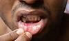 Frequent mouth ulcers? Here’s what your body may be trying to tell you