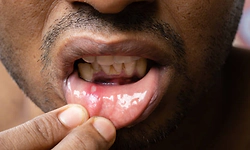 Frequent mouth ulcers? Here’s what your body may be trying to tell you