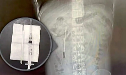Thermometer swallowed in childhood removed from man’s stomach after 20 years 