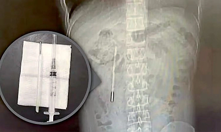 Thermometer swallowed in childhood removed from man’s stomach after 20 years 
