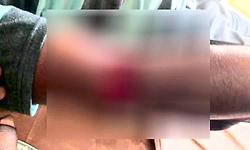 Punjalkatte: ಮೀಟರ್ ರೀಡರ್ ಮೇಲೆ ನಾಯಿ ದಾಳಿ