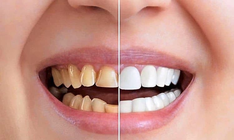 Teeth Whitening Tips: ನೈಸರ್ಗಿಕವಾಗಿ ಹಲ್ಲುಗಳನ್ನು ಬಿಳಿಗೊಳಿಸಲು 8 ಮನೆಮದ್ದುಗಳು