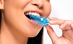 Mouth Guard: ಆರ್ಥೊಡಾಂಟಿಕ್‌ ಬ್ರೇಸ್‌ಗಳು ಮತ್ತು ಕ್ರೀಡಾಗಾಯಗಳು