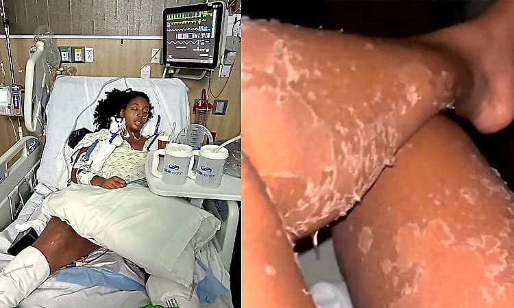 ಜೇಡ ಕಚ್ಚಿದ್ರೆ ಹೀಗೂ ಆಗುತ್ತಾ? ಸಾವು ಗೆದ್ದ ಮಹಿಳೆಯ ಭೀಕರ ಕಥೆ...