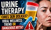 Urine therapy cures skin diseases? Viral wellness trend or dangerous myth