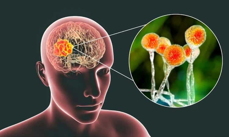 Kasaragod: ಅಮೀಬಿಕ್‌ ಮೆದುಳು ಜ್ವರ ಪತ್ತೆ... ಎಚ್ಚರವಹಿಸಲು ಸೂಚನೆ