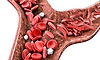 Sickle Cell: ರಕ್ತವು ತನ್ನ ಹೊರೆ ಹೊರಲಾರದಾದಾಗ: ಕುಡುಗೋಲು ರಕ್ತಕಣ ಕಾಯಿಲೆಯ ಜಾಗೃತಿ