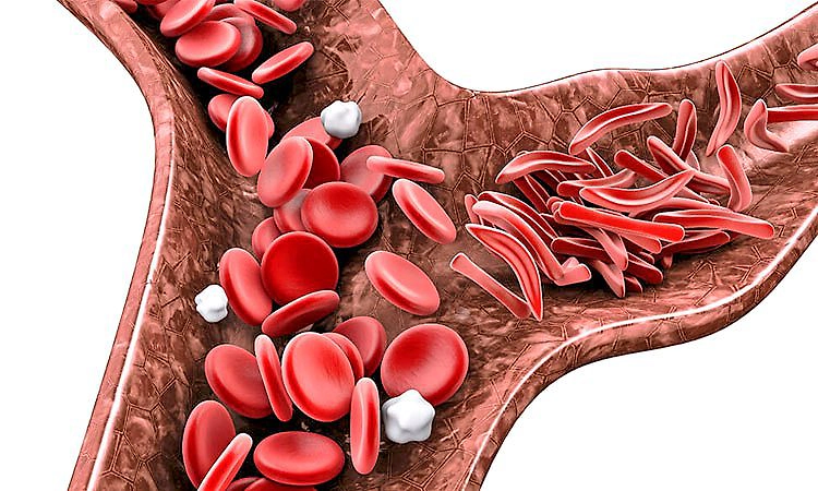 Sickle Cell: ರಕ್ತವು ತನ್ನ ಹೊರೆ ಹೊರಲಾರದಾದಾಗ: ಕುಡುಗೋಲು ರಕ್ತಕಣ ಕಾಯಿಲೆಯ ಜಾಗೃತಿ