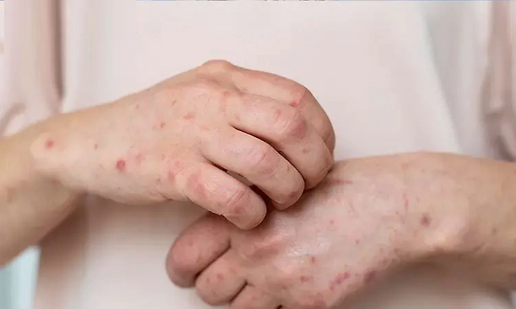 439 leprosy cases detected in DK, Udupi in six months; majority in second stage