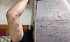 Hospital confirms pellet injuries in NEET protester as Delhi Police denies use of pellet guns