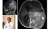Kasturba Hospital, Manipal, successfully removes large brain tumour in 15-day-old newborn