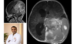 Kasturba Hospital, Manipal, successfully removes large brain tumour in 15-day-old newborn