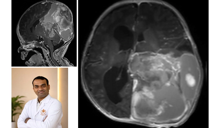 Kasturba Hospital, Manipal, successfully removes large brain tumour in 15-day-old newborn