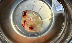 Vijayapura: ಕೀಹೋಲ್ ಶಸ್ತ್ರಚಿಕಿತ್ಸೆ ಮೂಲಕ ಹೃದಯದಲ್ಲಿನ ಗಡ್ಡೆ ಹೊರಕ್ಕೆ ತೆಗೆದ ವೈದ್ಯರು