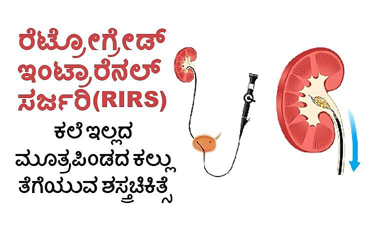RIRS: ಕಲೆ ಇಲ್ಲದ ಮೂತ್ರಪಿಂಡದ ಕಲ್ಲು ತೆಗೆಯುವ ಶಸ್ತ್ರಚಿಕಿತ್ಸೆ