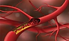 Cholesterol ಇಳಿಸುವ ʼಸ್ಟಾಟಿನ್‌' ಔಷಧ; ವಾಸ್ತವ ಗೊತ್ತಿರಲಿ