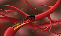 Cholesterol ಇಳಿಸುವ ʼಸ್ಟಾಟಿನ್‌' ಔಷಧ; ವಾಸ್ತವ ಗೊತ್ತಿರಲಿ