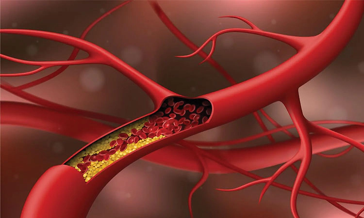 Cholesterol ಇಳಿಸುವ ʼಸ್ಟಾಟಿನ್‌' ಔಷಧ; ವಾಸ್ತವ ಗೊತ್ತಿರಲಿ