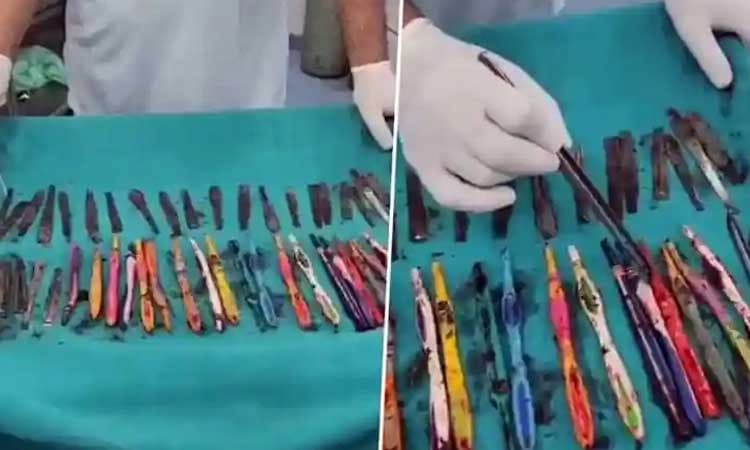 Doctors remove 2 pens, 19 toothbrushes, 29 spoons from drug addict's stomach in UP's Hapur