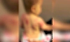 23-month-old bitten 25 times by another child at Maharashtra daycare