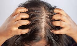 Analysis suggests common hair loss drug consumption by mothers may pose risks to infants