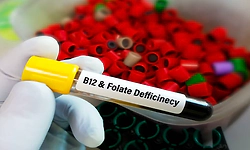 Vitamin B12, folate deficiencies could be related with fatigue, reduced motivation: Study