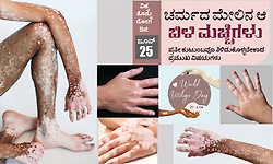 World Vitiligo Day:ಜೂನ್‌- 25: ವಿಶ್ವ ತೊನ್ನು ರೋಗ ದಿನ; ಚರ್ಮದ ಮೇಲಿನ ಆ ಬಿಳಿ ಮಚ್ಚೆಗಳು
