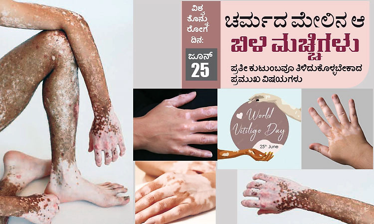 World Vitiligo Day:ಜೂನ್‌- 25: ವಿಶ್ವ ತೊನ್ನು ರೋಗ ದಿನ; ಚರ್ಮದ ಮೇಲಿನ ಆ ಬಿಳಿ ಮಚ್ಚೆಗಳು