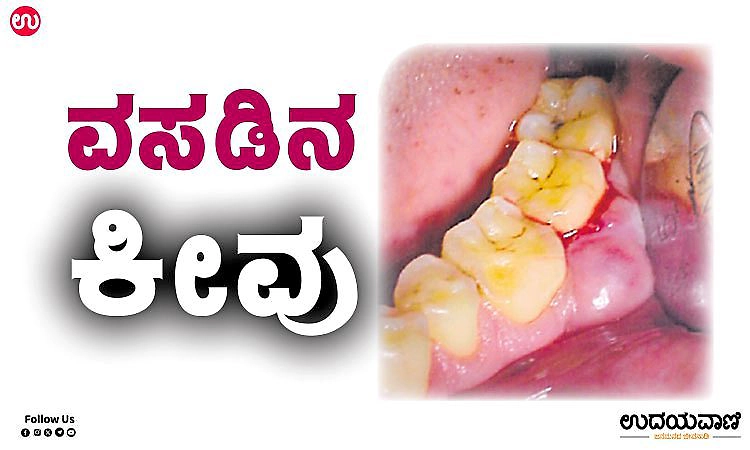 Tooth Gum: ವಸಡಿನ ಕೀವು