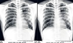 Mysuru: ಪಿಕೆಟಿಬಿ ಆಸ್ಪತ್ರೆ ಎಕ್ಸ್‌ರೇಯಲ್ಲಿ ಕನ್ನಡ ಬಳಕೆ